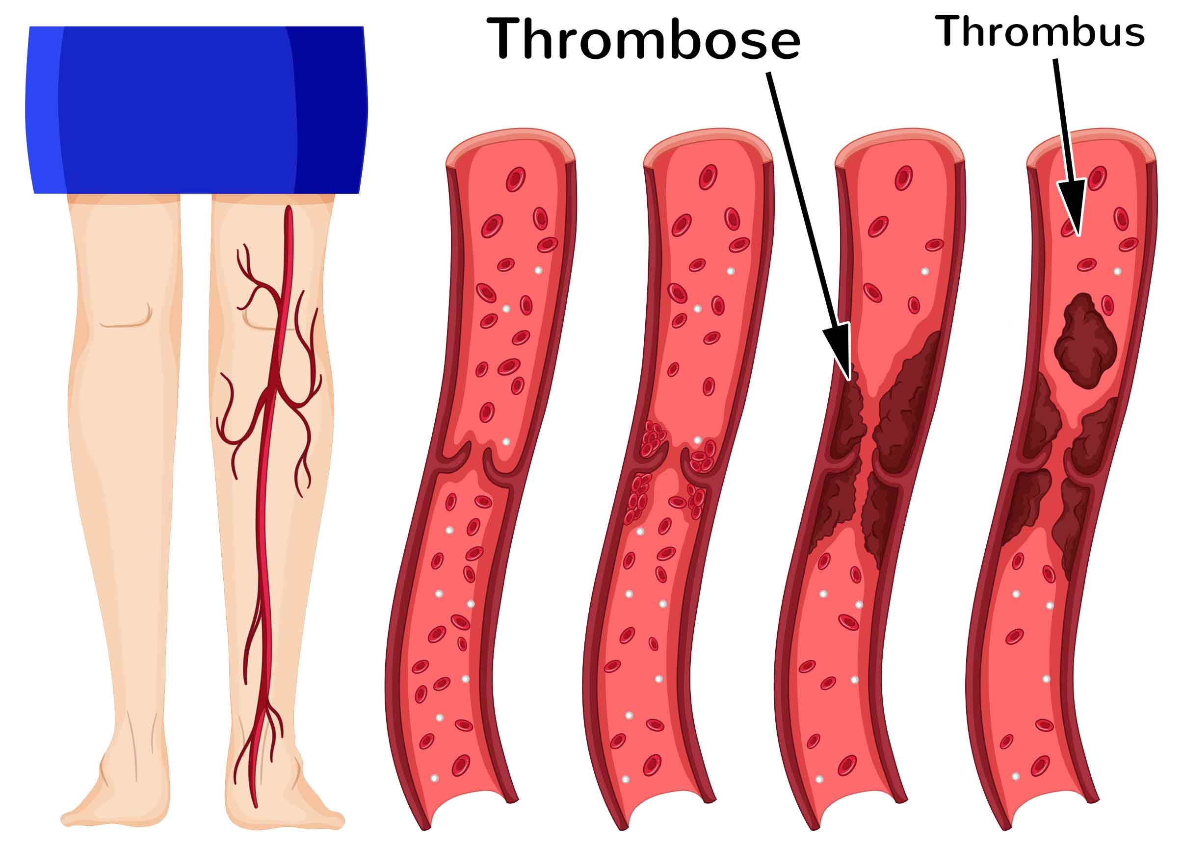 Как проверить есть ли в организме тромбы. Тромбоз кровеносных сосудов.